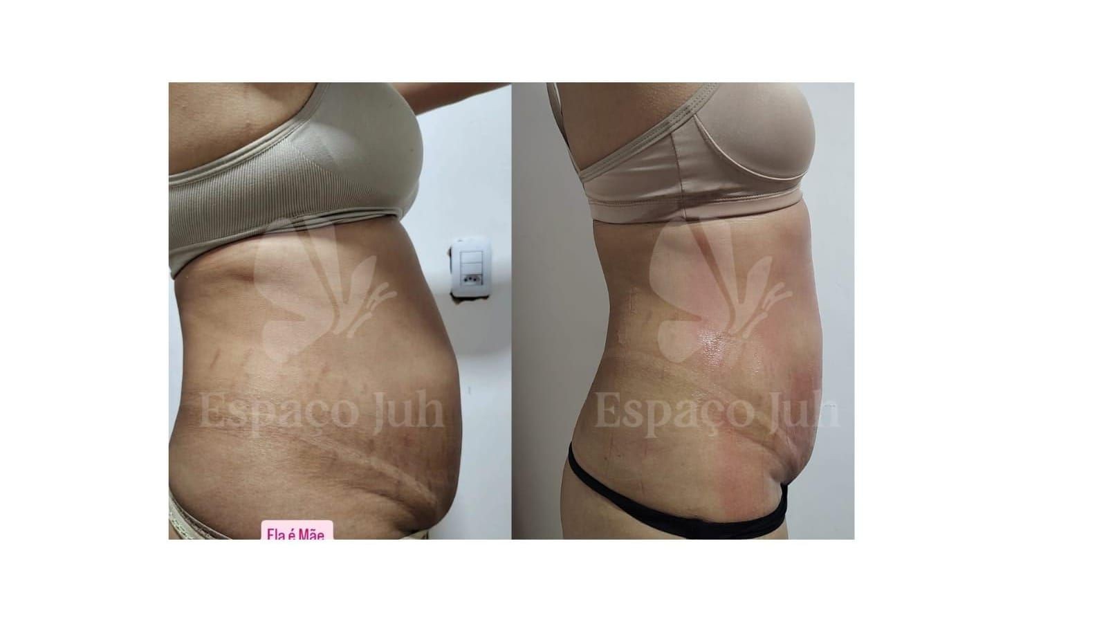 Before and after side view of a woman's midsection showing weight loss results.